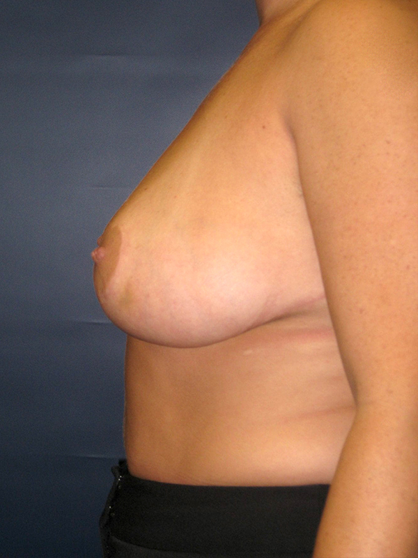 after-breast-reduction