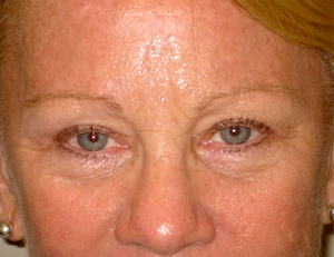 before & after blepharoplasty