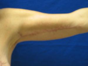 after arm lift