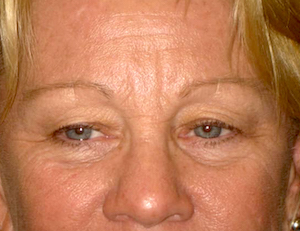 before & after blepharoplasty