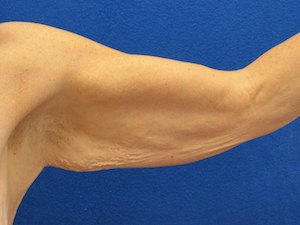 before arm lift